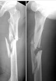 <p>bone shatters into small pieces</p>