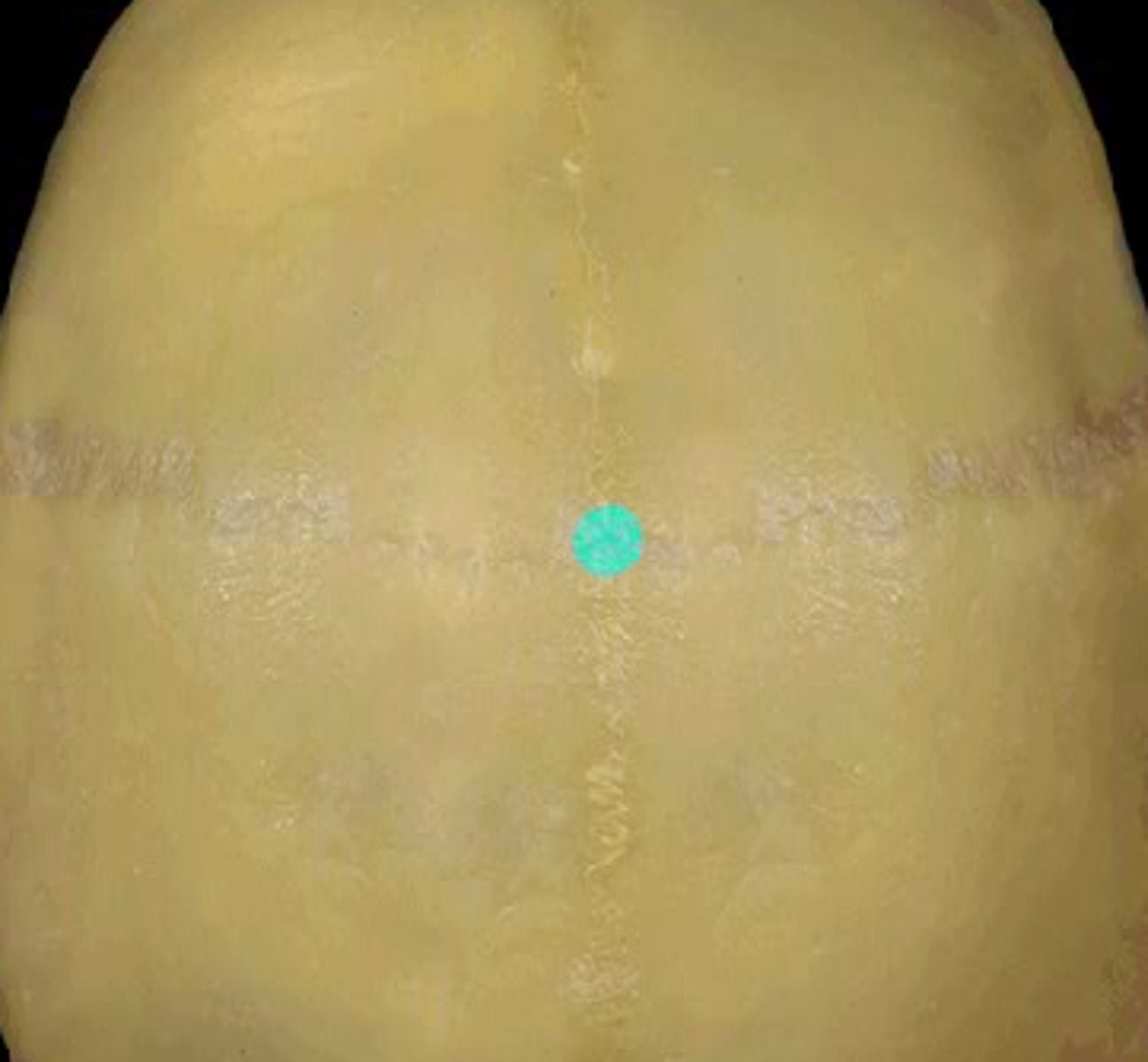 <p>Intersection of Coronal & Sagittal Sutures</p>