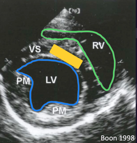 <p>Right parasternal short axis view</p>