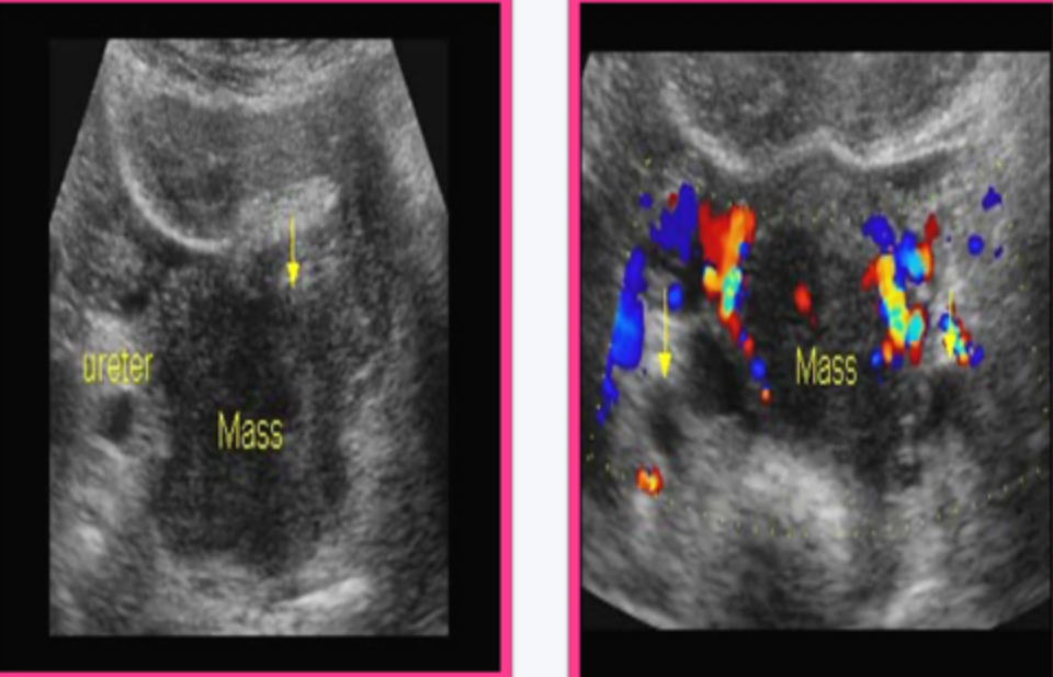<p>Cervical carcinoma appears on ultrasound as a _____, ________ mass and irregular ______ or _________ areas</p>