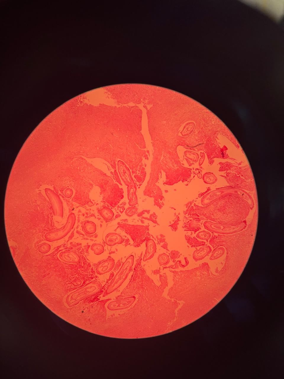 <p>Identificación: Onchocerca volvulus</p><p class="is-empty is-editor-empty has-focus">Tejido: nódulo</p><p class="is-empty is-editor-empty has-focus">Estructuras diagnósticas:</p><ul><li><p class="is-empty is-editor-empty has-focus">Cordón lateral prominente</p></li><li><p class="is-empty is-editor-empty has-focus">En las alargadas se ven gibosidades (ondulaciones en la cutícula). </p></li><li><p class="is-empty is-editor-empty has-focus">2 cavidades uterinas grandes</p></li><li><p class="is-empty is-editor-empty has-focus">Tracto digestivo pequeño</p></li></ul><p></p>