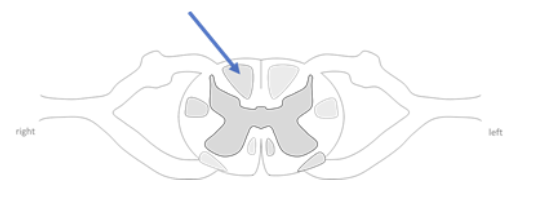 <p>A lesion to the tract in the imagine would result in an impairment of which of the following </p><ul><li><p>motor to trunk </p></li><li><p>motor to trunk + limbs </p></li><li><p>sensation of temperature </p></li><li><p>proprioception form the trunk + limbs </p></li></ul><p></p>