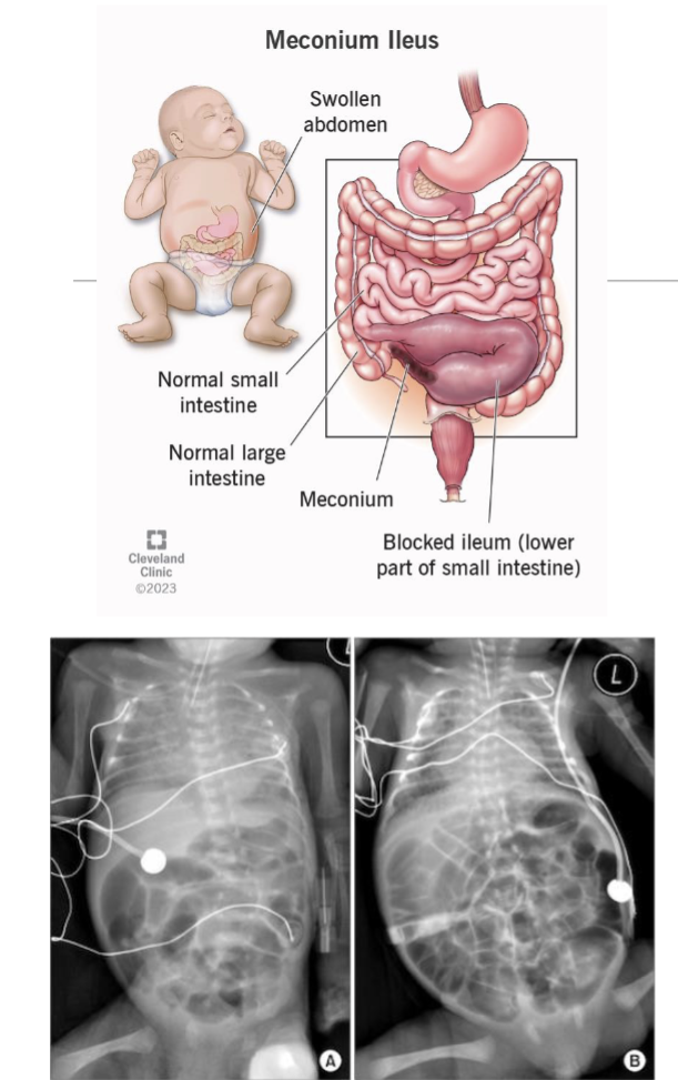 <p>Meconium ileus where thickened mucus accumulates in the ileum casuing abdominal distention and obstruction of GI tract&nbsp;</p><ul><li><p>treated with an enema(lubricant) applied via rectum(then surgery if not sucessful)</p></li></ul><p></p>