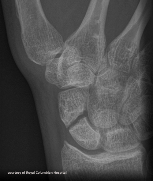 <p>Tenderness in anatomical snuffbox; commonly caused by FOOSH.</p>