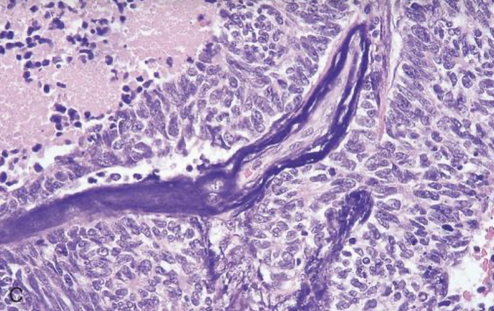 <p>as the cells break open, DNA will surround blood vessels in small cell carcinoma of the lung</p>