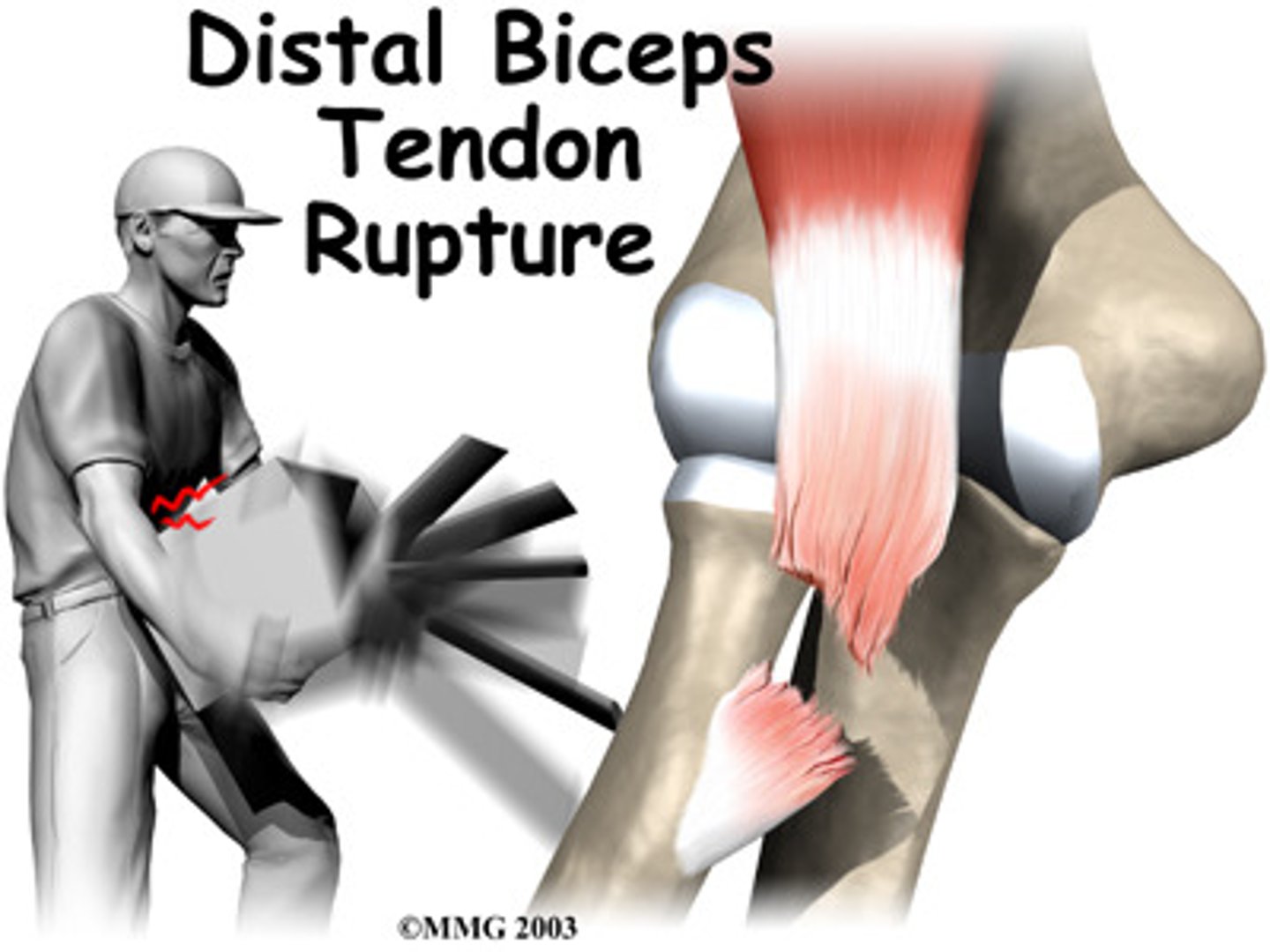 <p>- prolonged tendinitis</p><p>- degenerative - tendon weak</p><p>- traumatic - distal rupture</p>