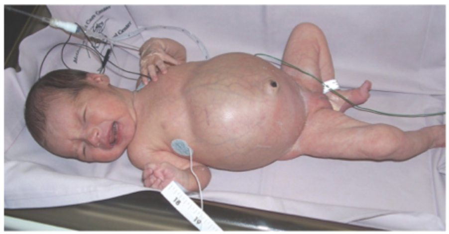 <p>Signs and Symptoms of NEC</p>