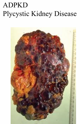 <p>-contains close to 400 proteins</p><p>-mutations of many of these genes lead to a variety of cystic kidney diseases</p><p>-also many other organ specific disease “ciliopathies”</p>