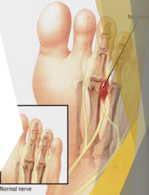 <p>Plantar (Morton’s) Neuroma</p>