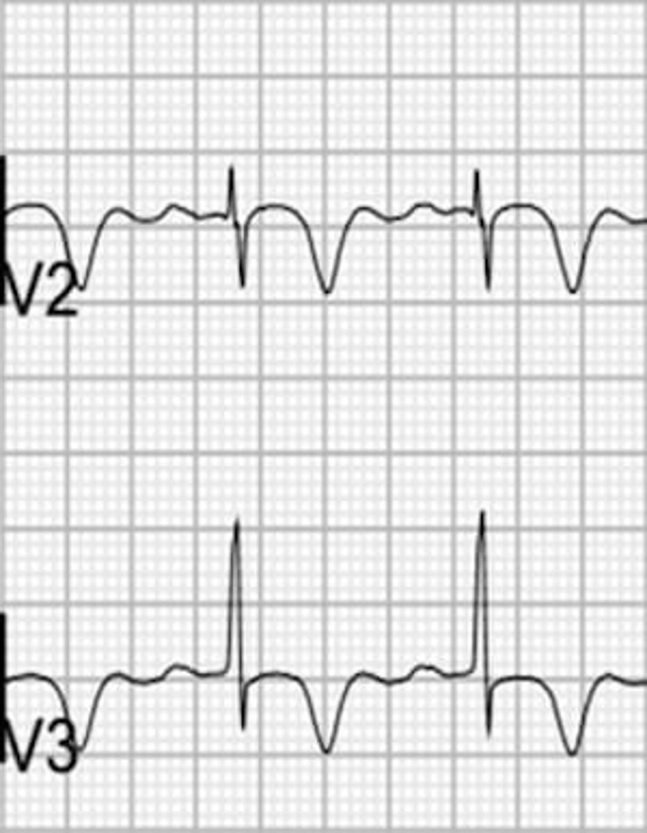 <p>- deeply inverted T wave in V2 and V3</p><p>- may spread to other precordial leads (75%)</p>