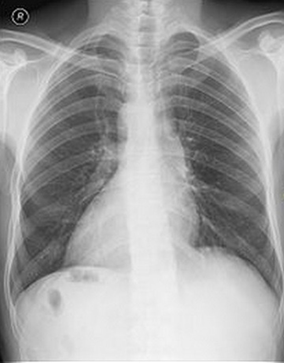<p>Kartagener syndrome (dynein arm defect affecting cilia)</p>