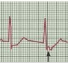 <p>P wave will appear after the QRS complex; most likely inverted</p>