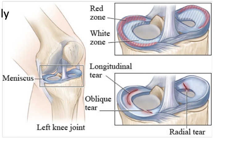 <p>Meniscus: Blood Supply </p><ul><li><p>Red Zone = </p></li><li><p>White Zone =</p></li></ul><p></p><p></p><p></p>
