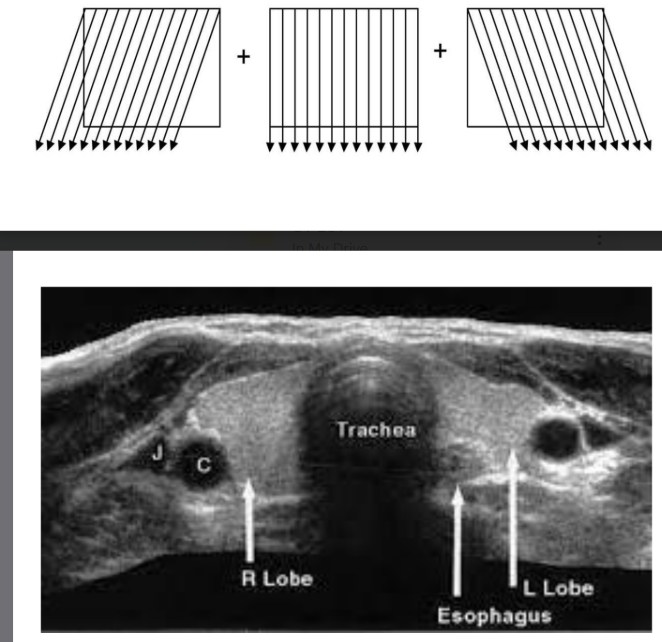 <p>(1) <strong><em>extends (widens)</em></strong> the field of view by physically moving the TDR across the patient to create a 2-D image over time</p><p>(2) echo data from previous planes are retained while new data is added from planes in other directions</p>