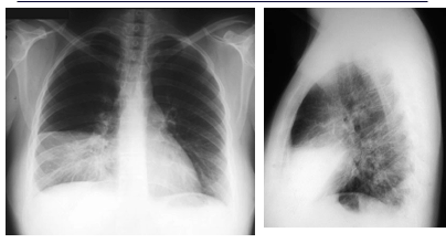 <p>RML pneumonia obscuring the cardiac border but not the R hemidiaphragm. Note the triangular density on the lateral view.</p>
