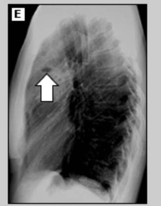 <p>44 y/o patient presents to the ER with cough. While collecting a history the patient reports a recent weight loss (15 lbs) without trying and malaise. She reports that the cough is wet and when she coughs up the sputum it smells terrible. Vitals are stable with the exception of a temp of 101.4. CXR shows thick walled solitary cavity surround by consolidation. What’s your treatment plan?</p>