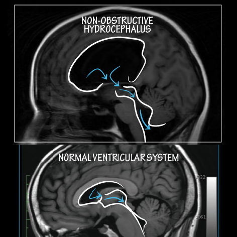 <p>Non-Obstructive Hydrocephalus</p>