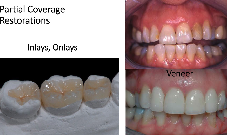 <ul><li><p>inlays</p></li><li><p>onlays</p></li><li><p>veneers</p></li></ul><p></p>