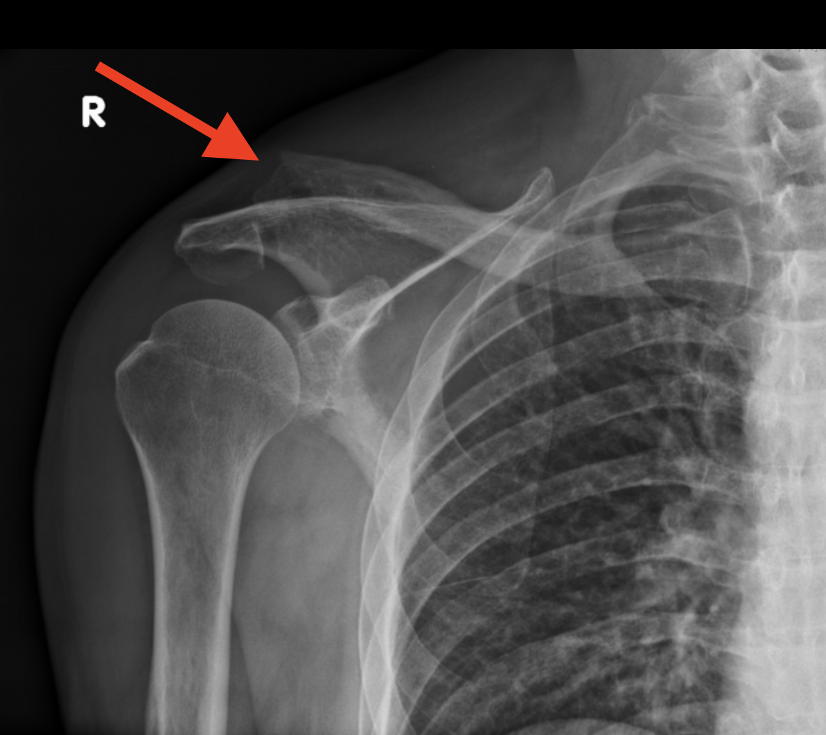<p>Tell me about distal clavicle fractures</p>