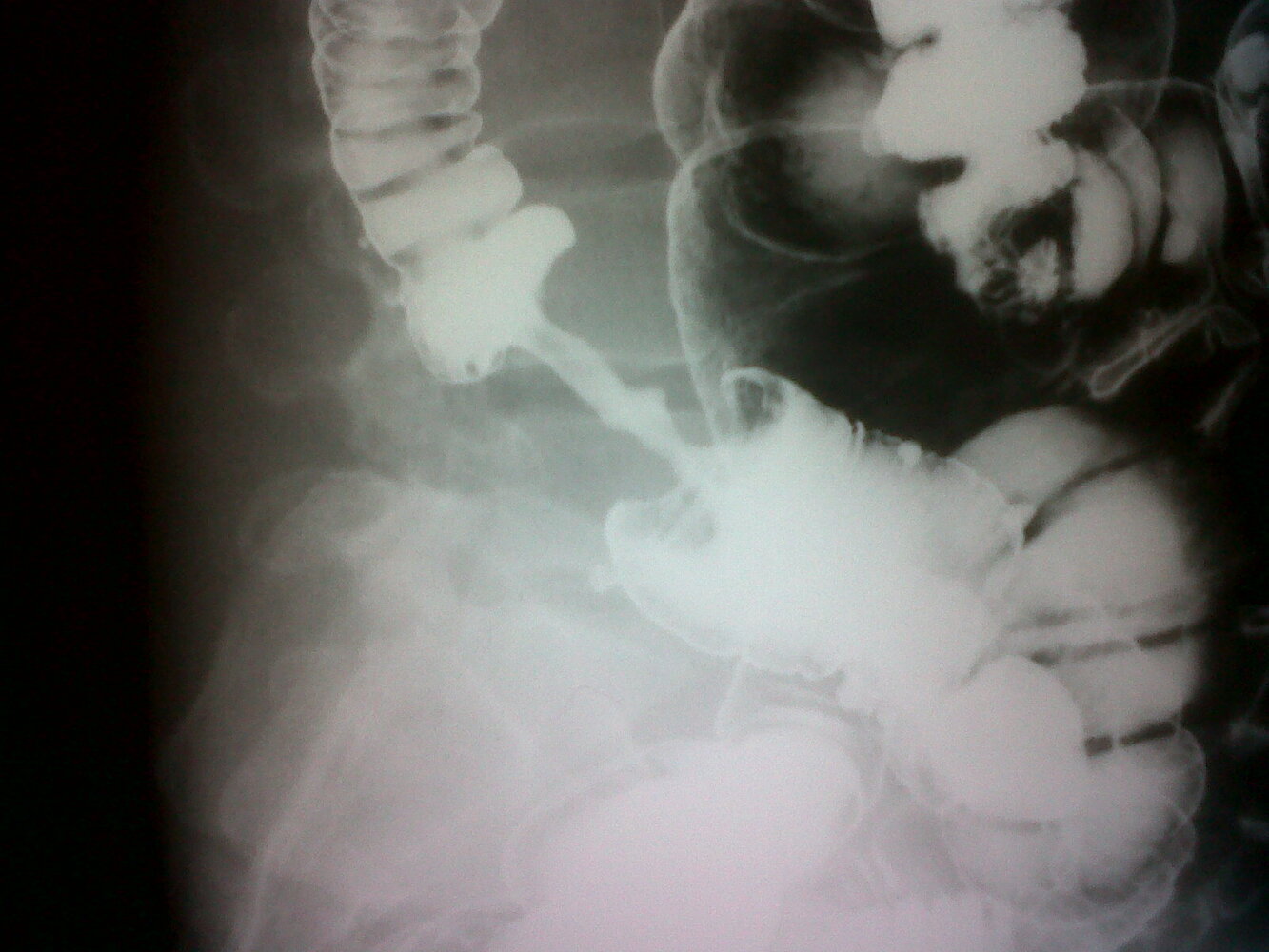 <p>What pathology is shown here?</p>