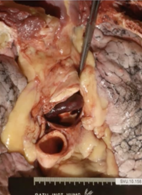 When someone sits still for a long time they could develop a thrombus in the leg, when they stand up and the circulation is fast again this thrombus travels to the heart and to the lungs → this is what causes a Saddle pulmonary embolism (when the thrombus is big). The saddle is where the thrombus is trapped. LETHAL 