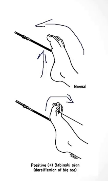 <p>-run hand up the bottom of the foot</p><p>-toes curl downwards/plantarflex</p><p>-toes curl upwards/dorsiflex; incomplete myelination</p><p>-toes curl upwards/dorsiflex; upper motor neuron damage</p>