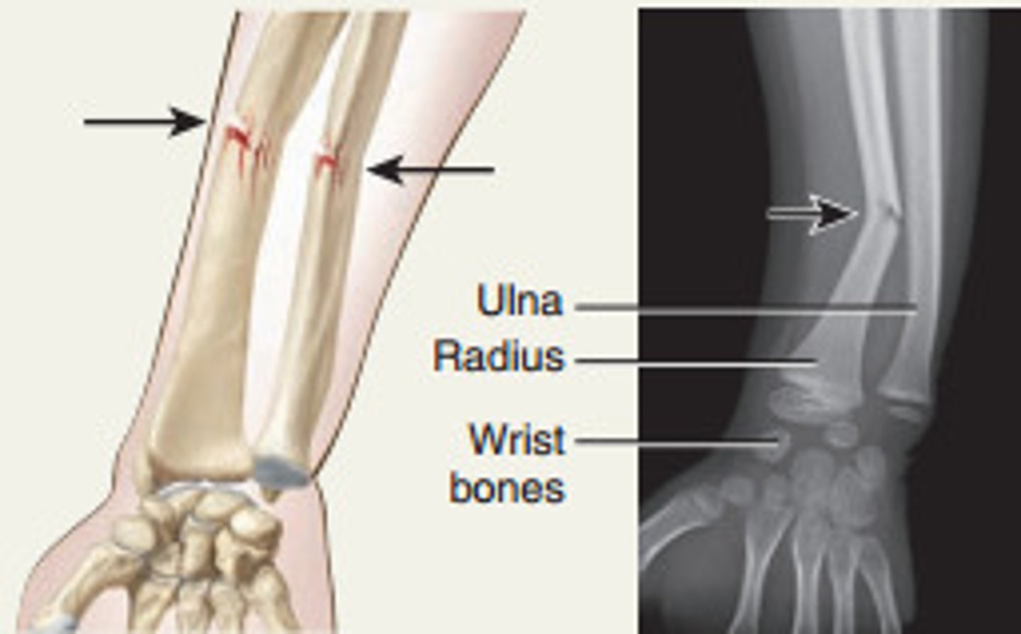 <p>special case, usually only in kids, happens when your bones are softer, incomplete break like bending a green twig and it breaks on one side</p>