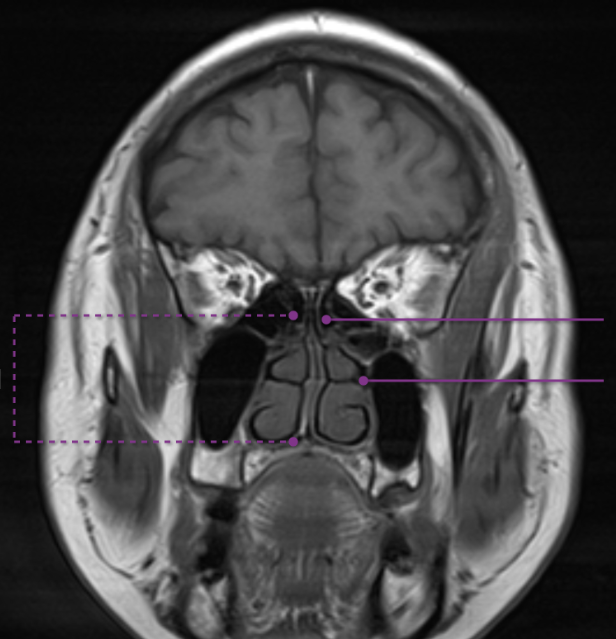 <p>ethmoid sinuses</p>