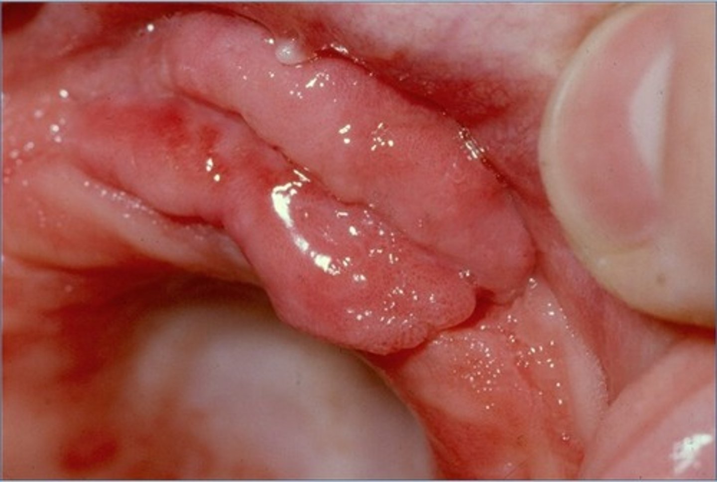 <p>"Fibroma" Around denture flange, caused by ill fitting denture.</p><p>Treatment: Remove excess tissue and reline or replace denture</p>