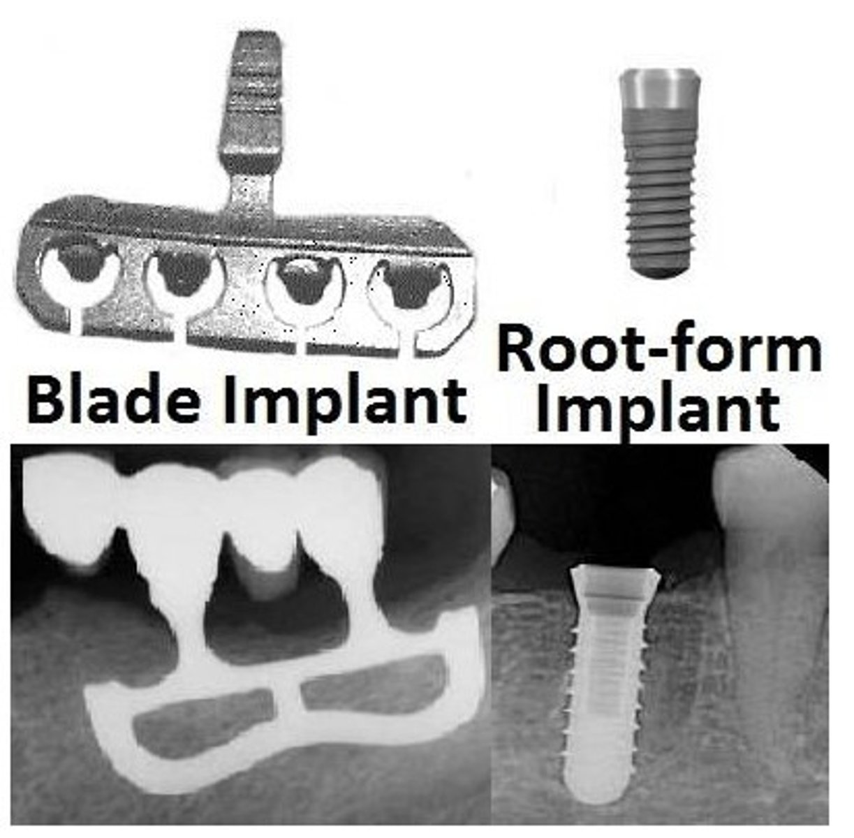 <p>root-form endosseous implants</p>