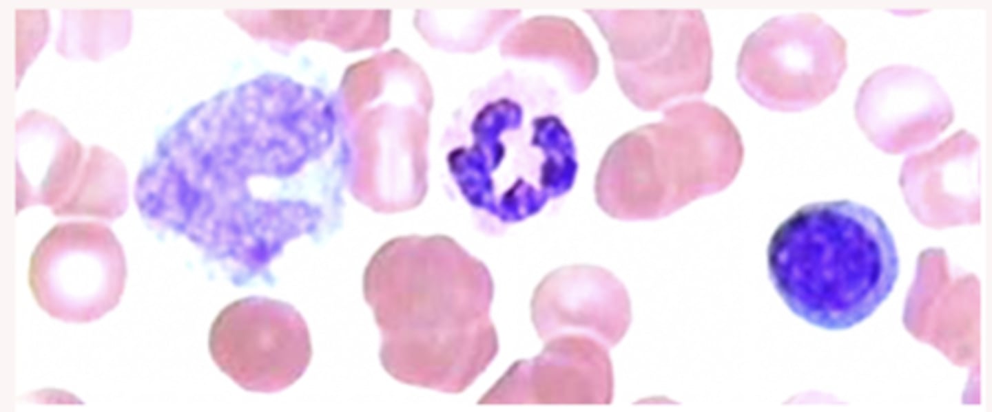 <p>In Romanosky staining, in which acidic (red) and basic (blue) dyes are used together, polychromasia means:</p><p>A) Some cels are stained red, some blue, and some white (unstained)</p><p>B) Different sub-cellular structures of the same cell have different colors</p><p>C) A shift of the color of the basic dye</p><p>D) Resulting purple color caused by the complex formation of red and blue dyes</p>