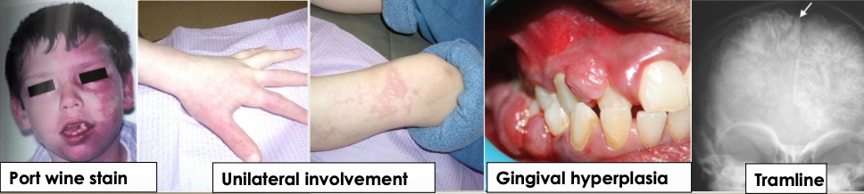 <p>What are the clinical manifestations of sturge-weber angiomatosis?</p>