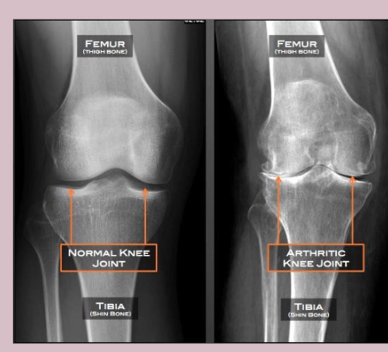 <p>cartilage</p>