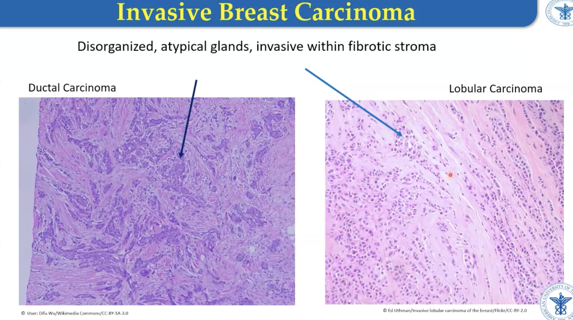 <p>Lobular - cells like to line up one behind the other</p><p>Disordered and atypical</p>