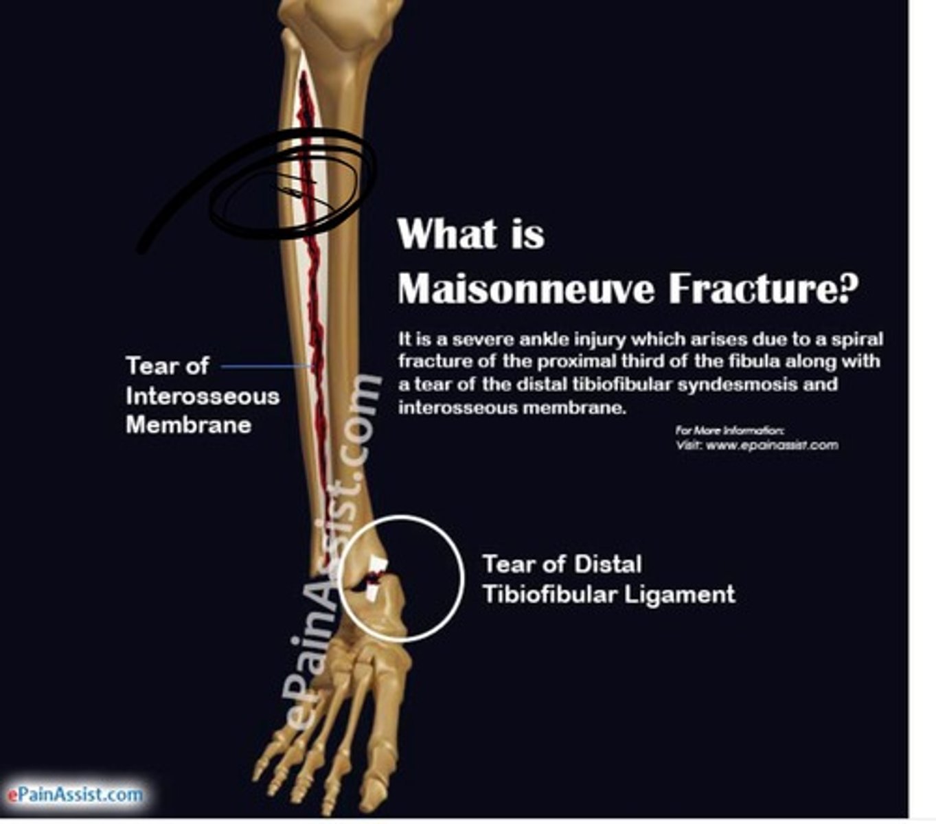 <p>Maisonneuve fracture → fracture of medial malleolus and spiral fx of proximal fibula</p><p>d/t pronation and external rotation</p>