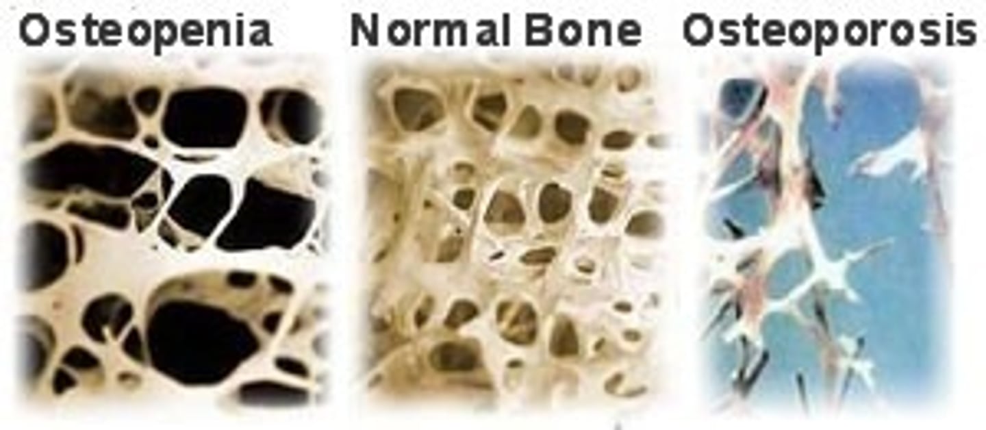 <p>Abnormal reduction of bone mass</p>