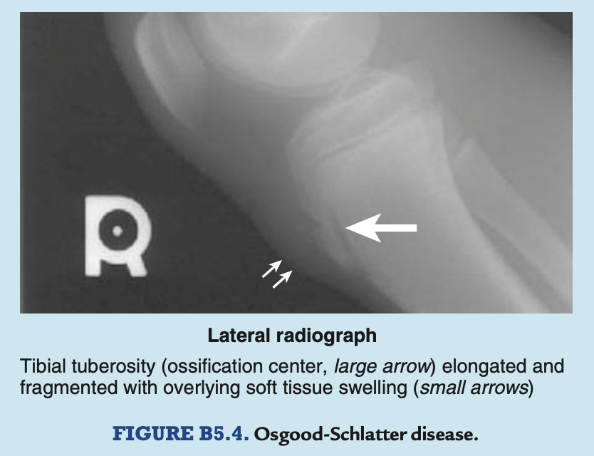 <p>may cause inflammation of the tuberosity and chronic recurring pain during adolescence (Osgood-Schlatter disease), especially in young athletes</p>