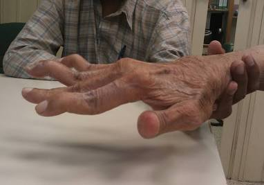 <p>What deformity is this?</p><p>-Associated with RA, characterized by the hyperextension of the PIP joint and flexion of the DIP joint </p>