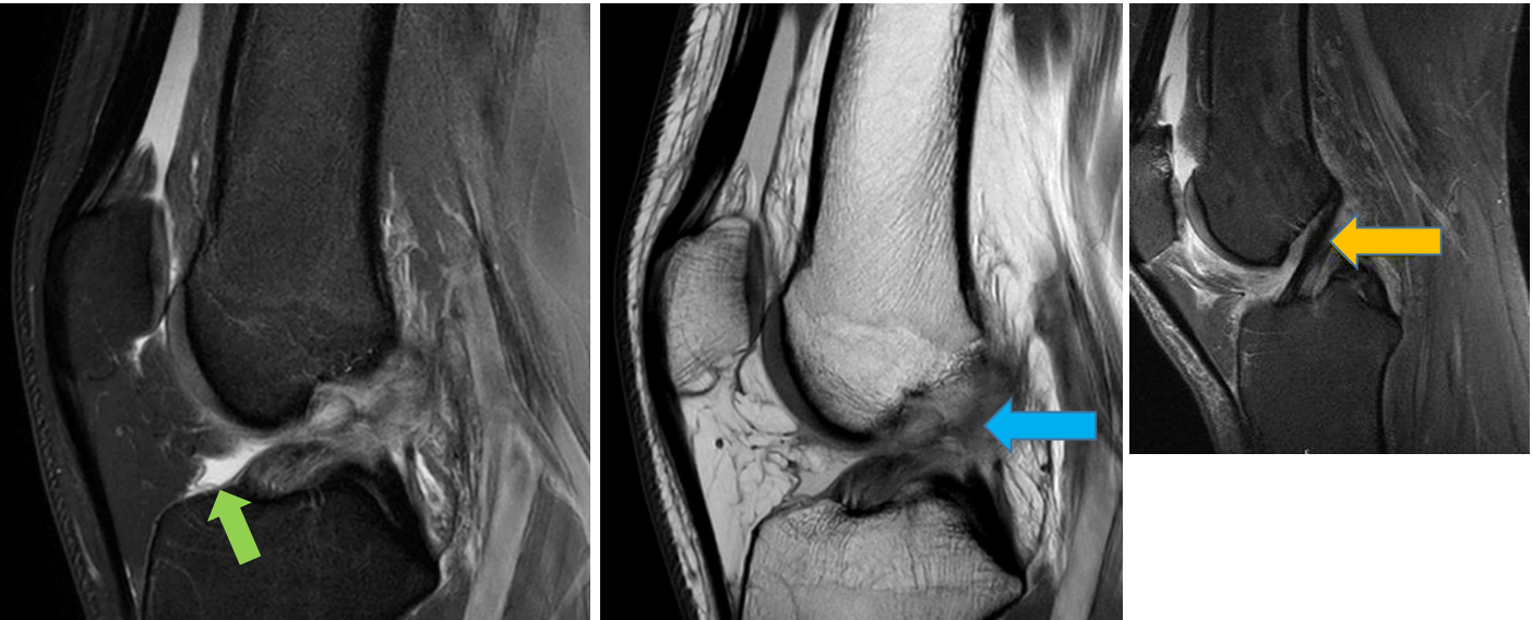 <p>Patient history: young patient with unstable knee after ski accident</p><p>Modality: left– fatsat Proton Density (PD) MRI (sagittal view); middle – PD MRI (sagittal view); right (smaller) image – normal anatomy (normal, hypointense anterior crucial ligament marked with yellow arrow, visible through its whole length); without iv. contrast administration </p><p>Region: knee </p><p>Radiologic sign: normal anterior crucial ligament cannot be detected (blue arrow), small amount of hyperintense synovial fluid (green arrow) </p><p>Diagnosis: tear of the anterior crucial ligament caused by sport injury</p>