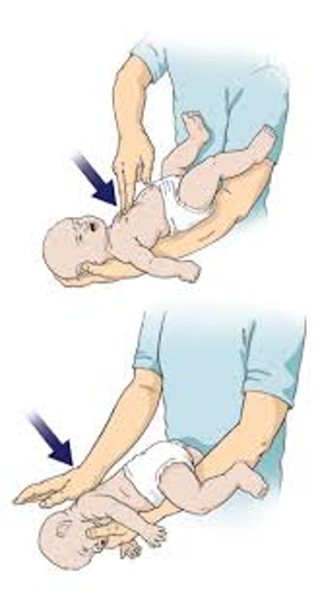 <p>1. sit or kneel w/ the baby face-down along your forearm, holding the baby in your hand.</p><p>2. deliver 5 back blows b/w shoulder blades</p><p>3. if object doesn't exit body, flip baby face-up and support its head</p><p>4. place 2 fingers in the middle of the chest and do 5 chest compressions. repeat 5 bb and 5cc until object comes out</p>