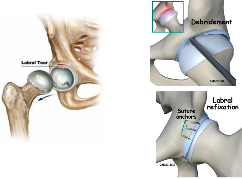 <p>when labrum is compromised → friction stresses increases → articular cartilage deterioration → hip osteoarthritis</p>