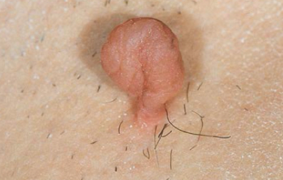 <p>what lesion is depicted</p>