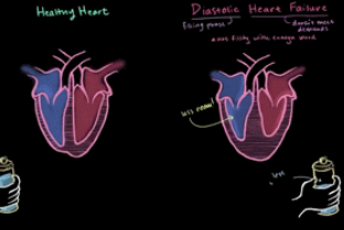 <p><span style="font-family: &quot;Century Gothic&quot;, sans-serif;">Inability of the left ventricle to accommodate blood volume during diastole at low to normal filling pressures.</span></p><ul><li><p>this can occur from the ventricles working too hard and the muscles becoming too large, making the chamber smaller and not able to fill as much</p></li></ul><p></p>