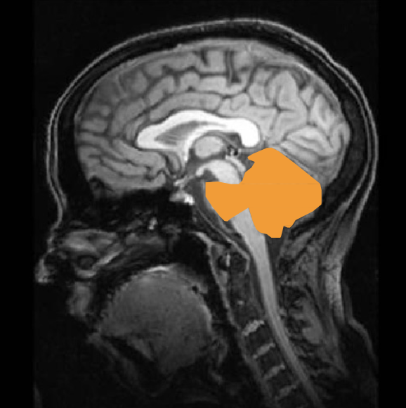 <ul><li><p>ventral side: pons - lots of tracts, strokes can cause sensory/motor impairments, difficulties with wakefulness</p></li><li><p>dorsal side: cerebellum - critical for motor coordination, but being born without is manageable (damaging it later on is difficult)</p><ul><li><p>alcohol affects cerebellum and balance when drunk</p></li></ul></li></ul><p></p>