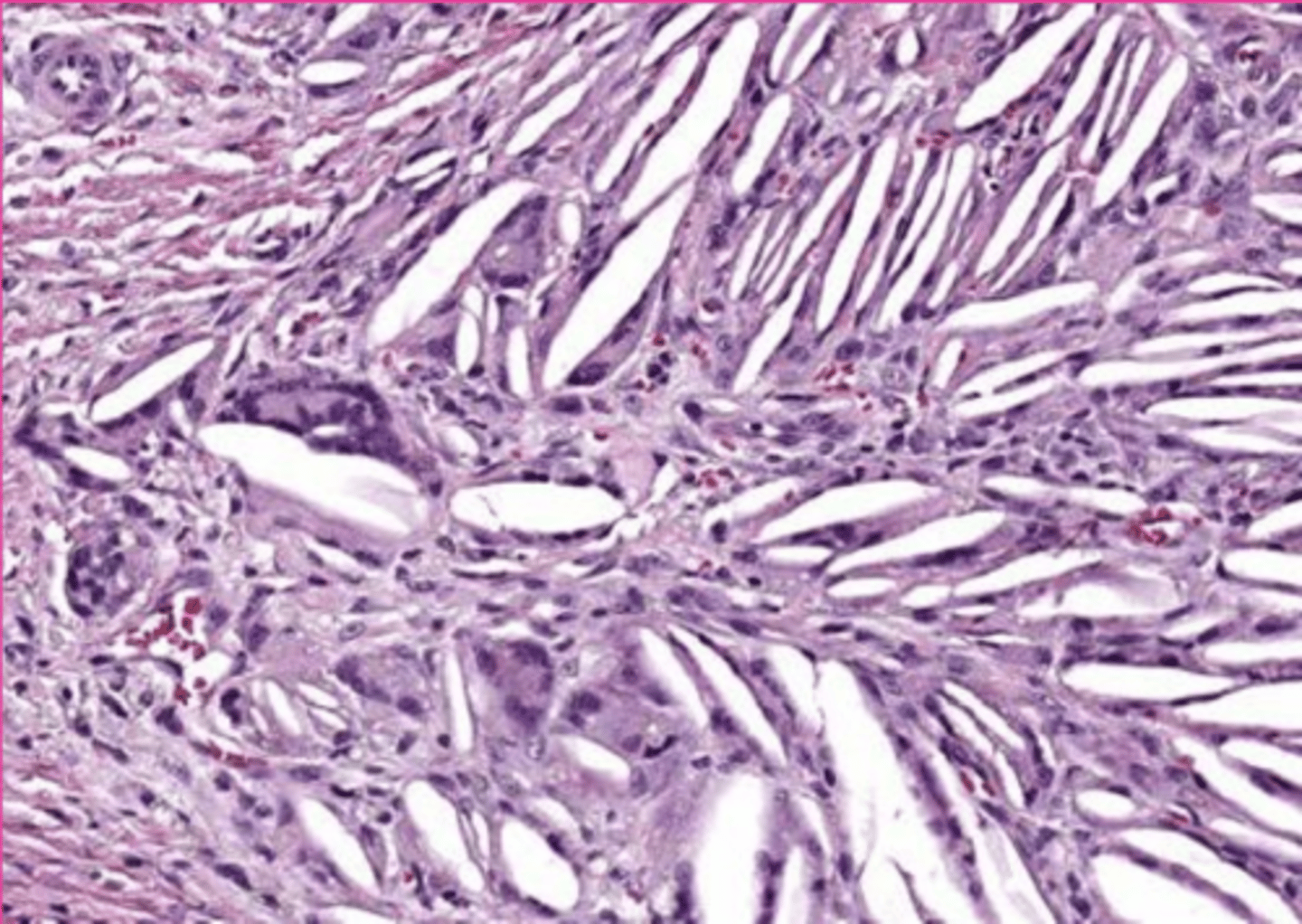 <p>what is this extracellular accumulation?</p>