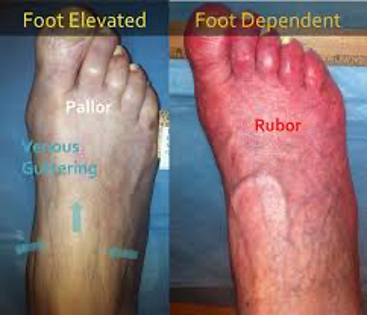 <p>A = Pale to dependent rubor, more common with advanced disease</p><p>V = Normal to dusky-ruddy color, Cyanotic with advanced disease</p>