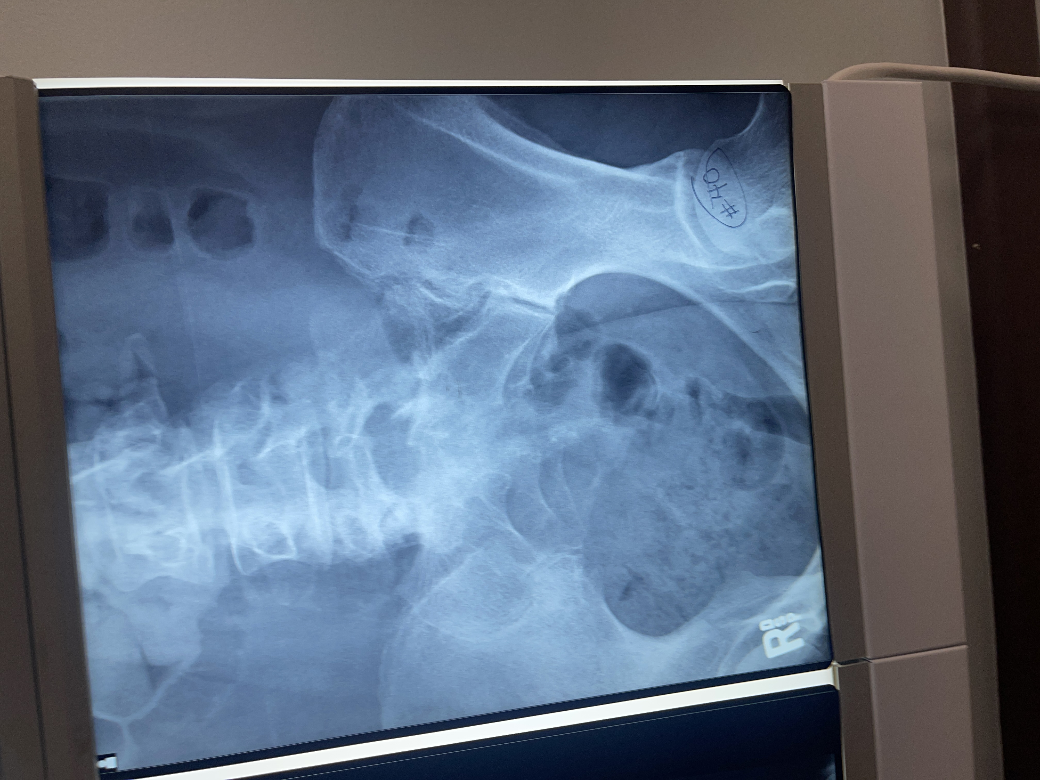 <p>What’s wrong with #40 AP axial oblique of the left SI joint</p>