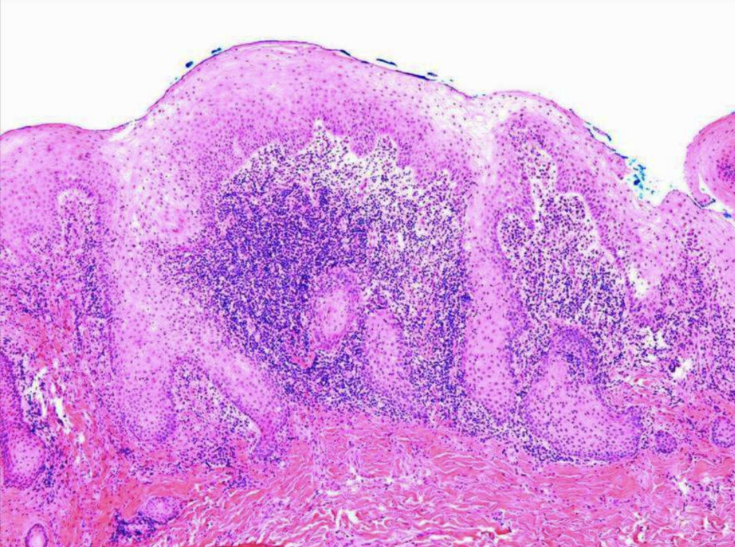 <ul><li><p>papillary growths on surface</p></li><li><p>pseudoepitheliomatous hyperplasia</p></li><li><p>Sialadenitis (inflammation of salivary glands)</p></li></ul><p></p>