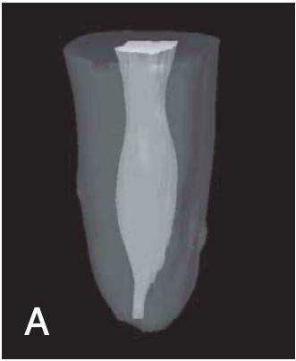 <p><span>(merging type) </span></p><p><span>canals merge to one main canal before exiting at the apical foramen</span></p>