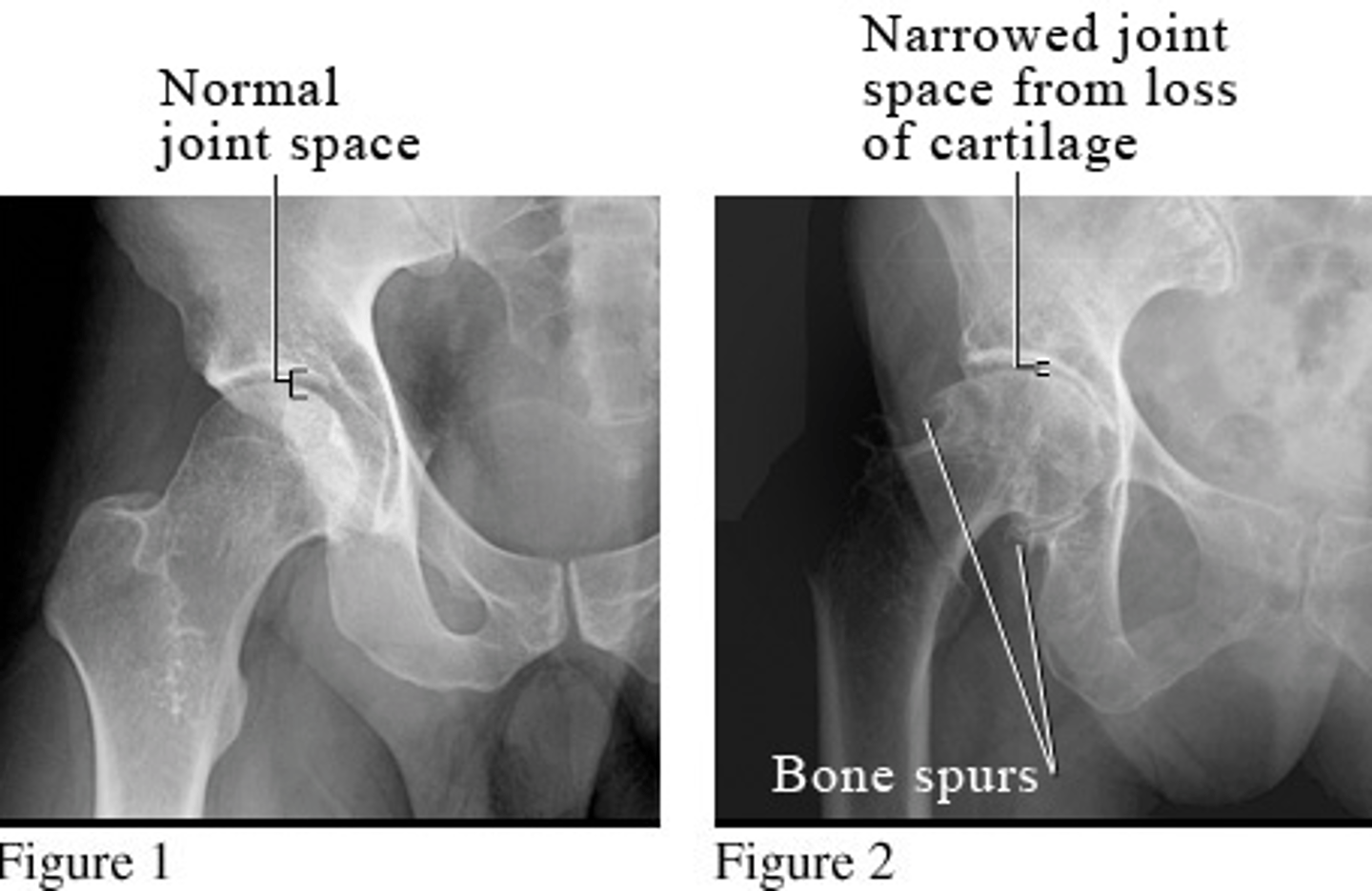 <p>wear and tear arthritis </p><p>*occurs equally in males and females</p><p>**associated with trauma (50%) or idiopathic (50%)</p><p>***increased with height to weight ratio</p><p>STRUCTURES--&gt; joints, primarily weight-bearing</p><p>FUNCTIONAL DEFICITS--&gt; decreased ROM, pain</p><p>COMPENSATORY MOVEMENTS--&gt; antalgic gait pattern, may present with Trendelenberg gait due to muscle weakness, or may see gluteus medius gait</p><p>*associated with a high percentage of total hip replacement</p>